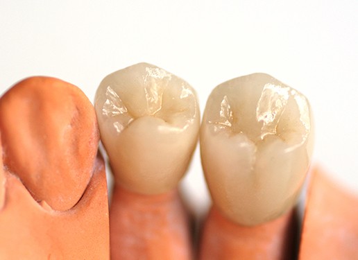 dental crowns side by side