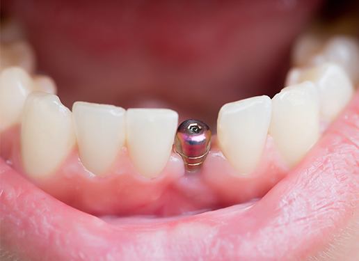 silver part of implant inbetween teeth