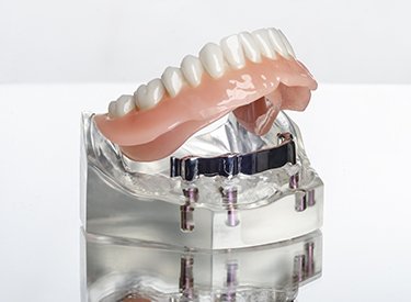 complete bottom denture implant