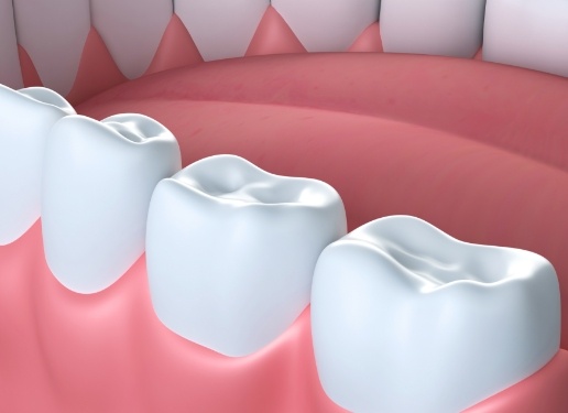 computer illustration of a dental sealant